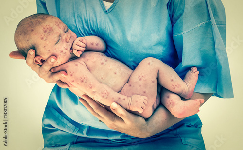 Obraz na plátně Newborn baby with chickenpox