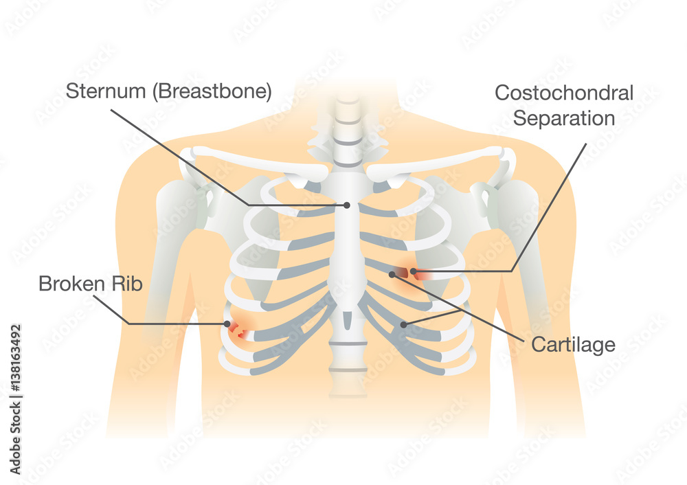 Human rib bone fractures fracture. Illustration is description of body ...