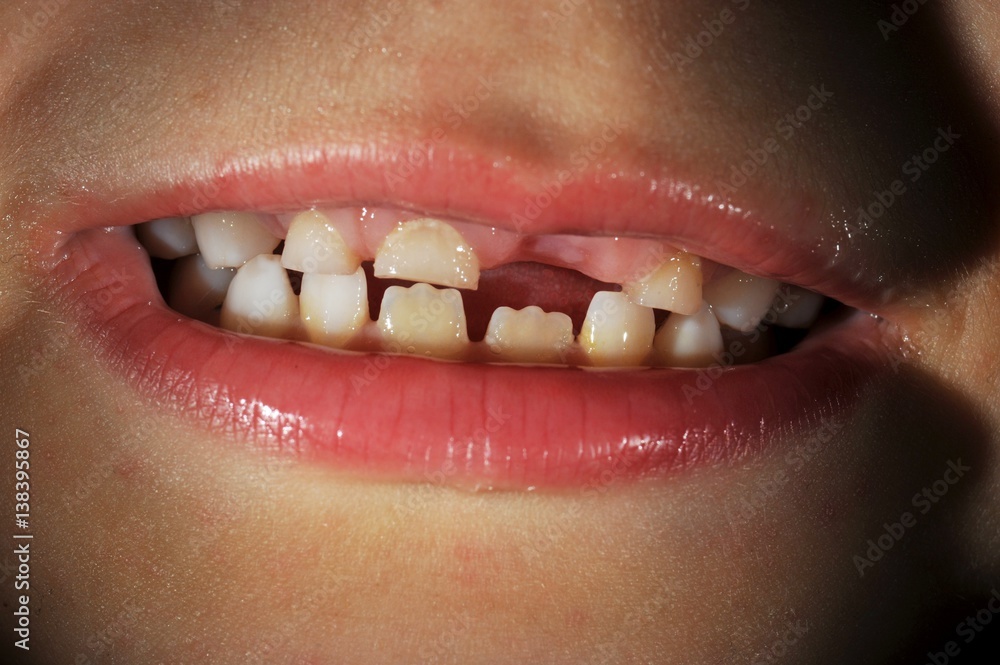 Obraz premium Milchzahngebiss eines 6-jährigen Jungen (Dens&nbsp;caducus)