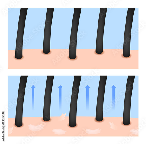 hair skin lose their moisturizer and turn to dandruff vector