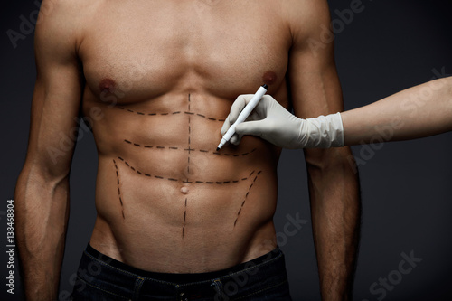 Obraz na plátně Plastic Surgery. Doctor Hand Drawing Black Marks On Patient Body