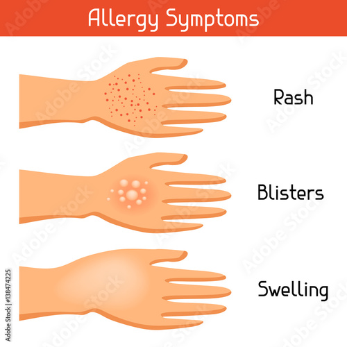 Allergy symptoms. Vector illustration for medical websites advertising medications