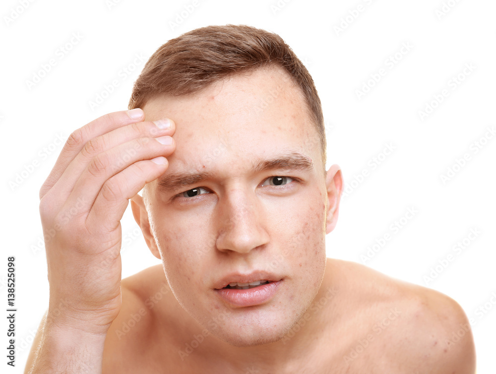 Handsome young man with problem skin on white background Handsome young man with problem skin on white background
