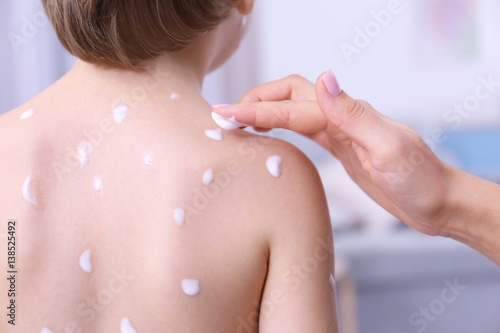 Obraz na plátně Woman applying cream onto skin of child ill with chickenpox, closeup
