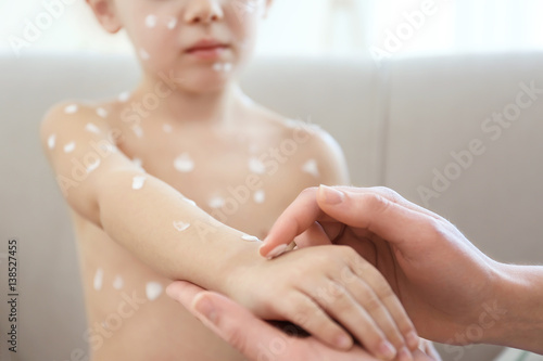 Fotografie Female hands applying cream onto skin of child ill with chickenpox, on blurred b
