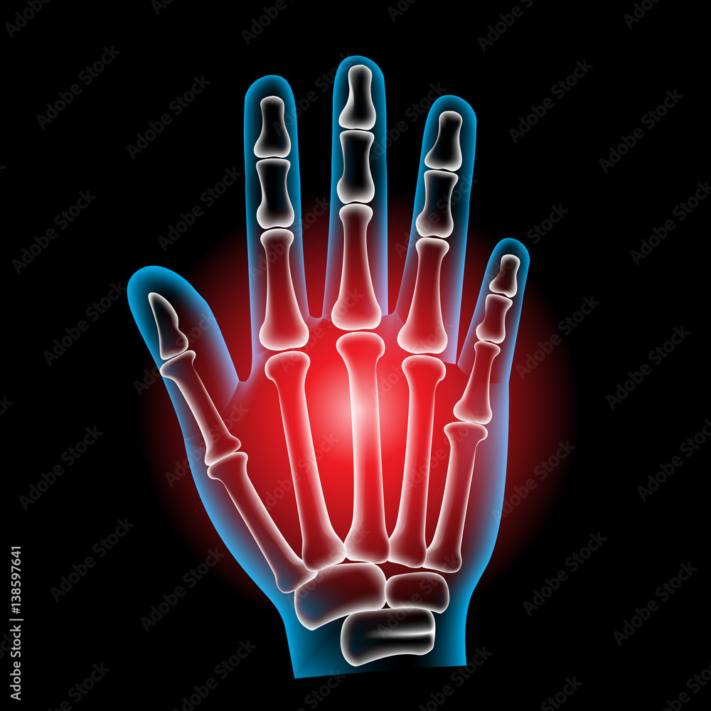 Vetor de Finger bone, pain, x ray, Broken finger do Stock Adobe Stock