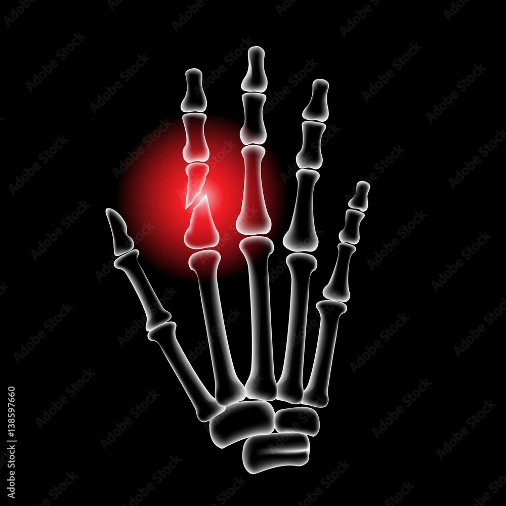 Finger bone, pain, x ray, Broken finger Stock Vector Adobe Stock