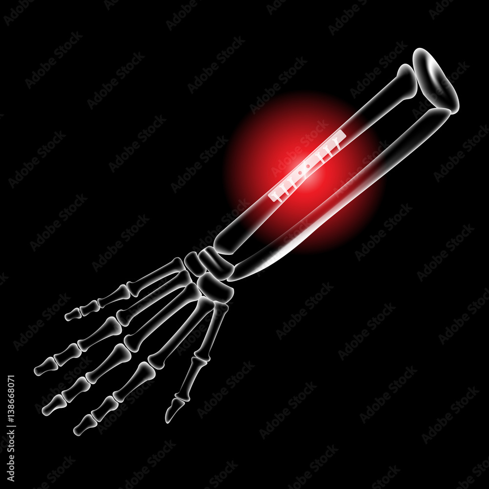 Arm bone and finger bone, pain, x ray, broken arm, Pins and screws to hold the bones Stock
