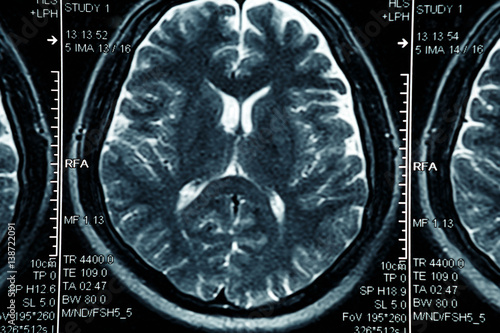 MRI or magnetic resonance image of head and brain scan. Close up view