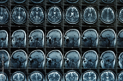MRI or magnetic resonance image of head and brain scan. Close up view