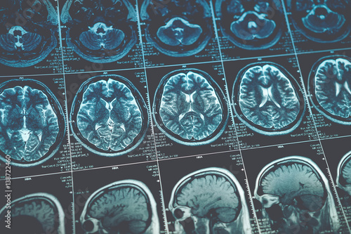MRI or magnetic resonance image of head and brain scan. Close up view
