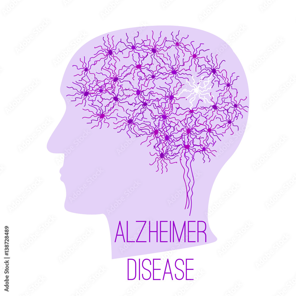 alzheimer disease concept alzheimer disease concept