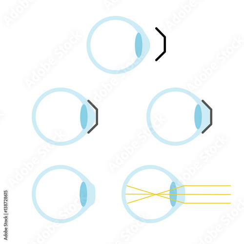 orthokeratology mechanism principle
