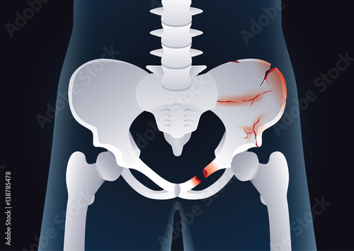 Fractures of the pelvic. Illustration about body injury.