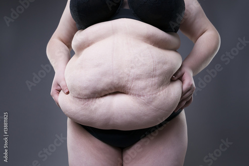 Fat female belly, overweight body, woman with stretch marks on abdomen photo