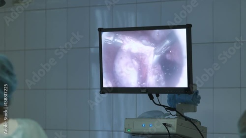 Type of procedure on the monitor during surgery photo