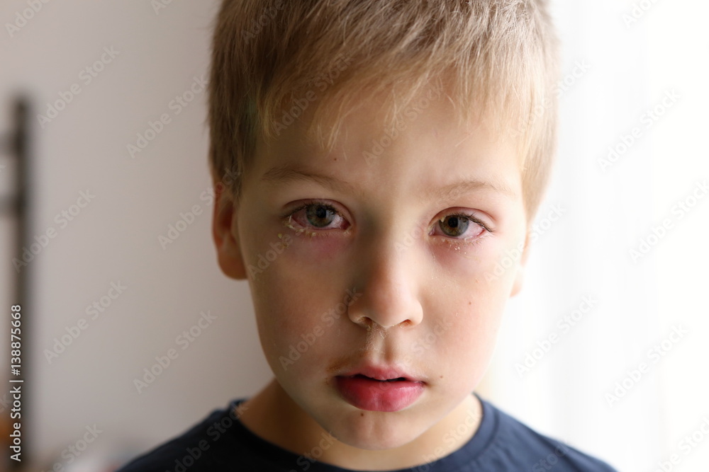 Detail of the boy with conjunctivitis (red eyes) Detail of the boy with conjunctivitis (red eyes)