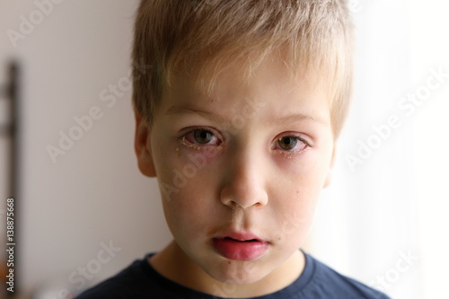 Detail of the boy with conjunctivitis (red eyes) photo
