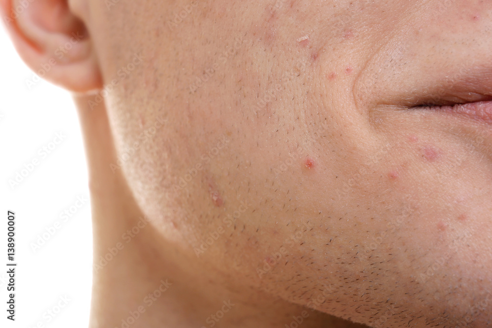 Face of handsome young man with problem skin, closeup Face of handsome young man with problem skin, closeup