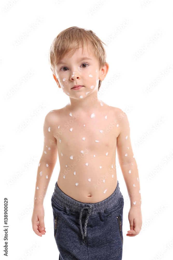 Cute little boy with chickenpox on white background Cute little boy with chickenpox on white background