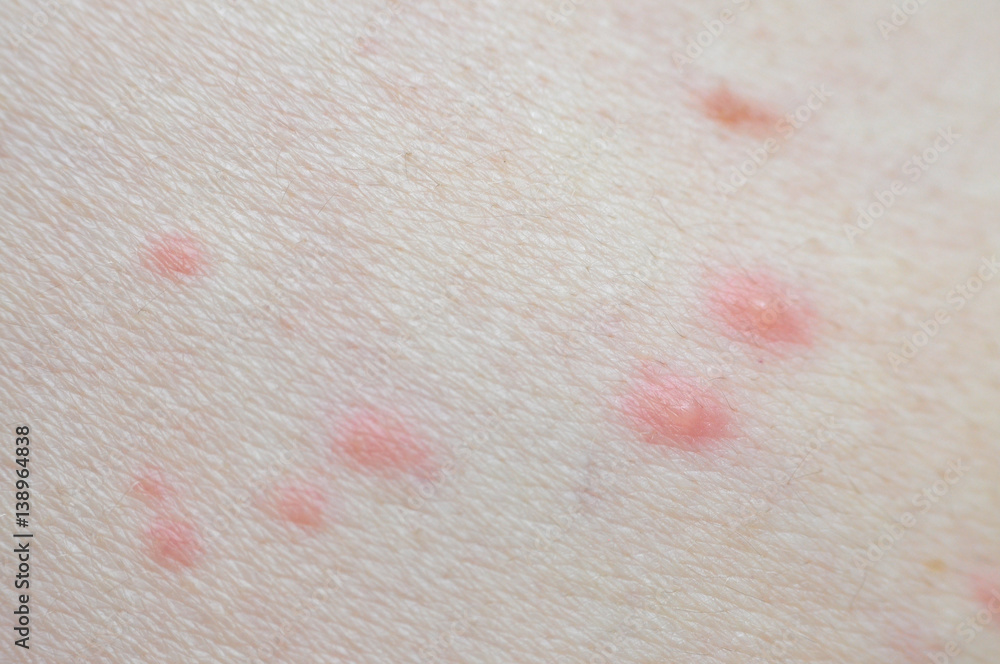 Fototapeta premium Chickenpox (varicella) closeup. Pox or smallpox closeup