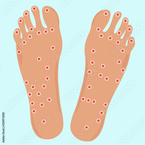 Acupuncture points on foots photo