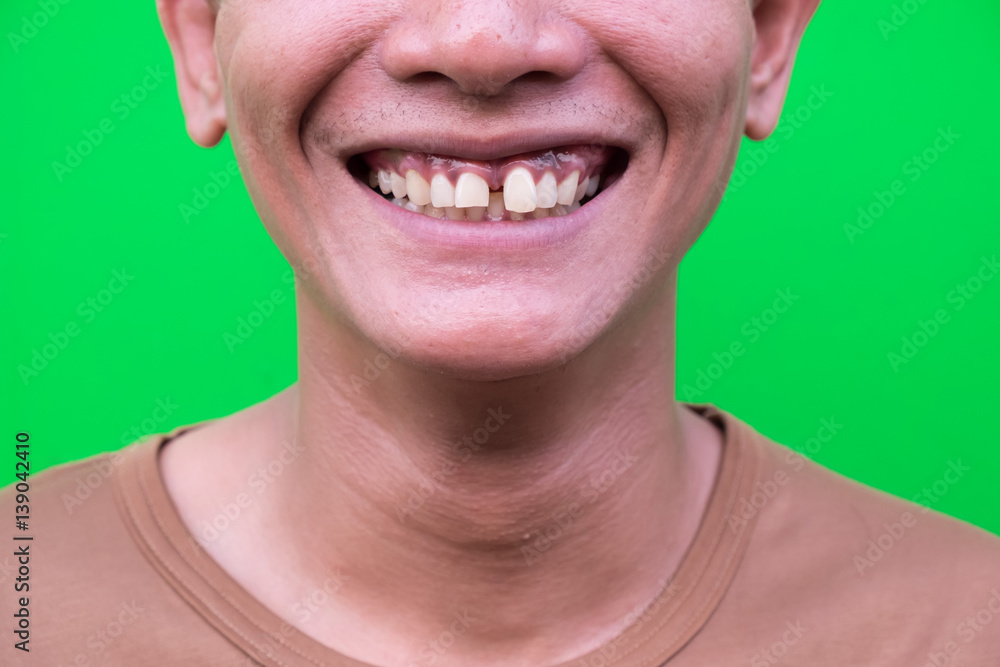 Obraz premium Asian man smiling showing his teeth unattractive on green background. Selective focus.
