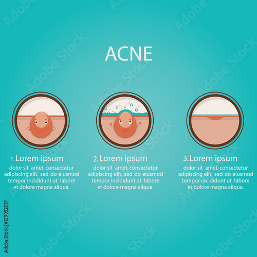 Modern vector illustration of skin problems. Dark dots, acne. Face care. Template for website.