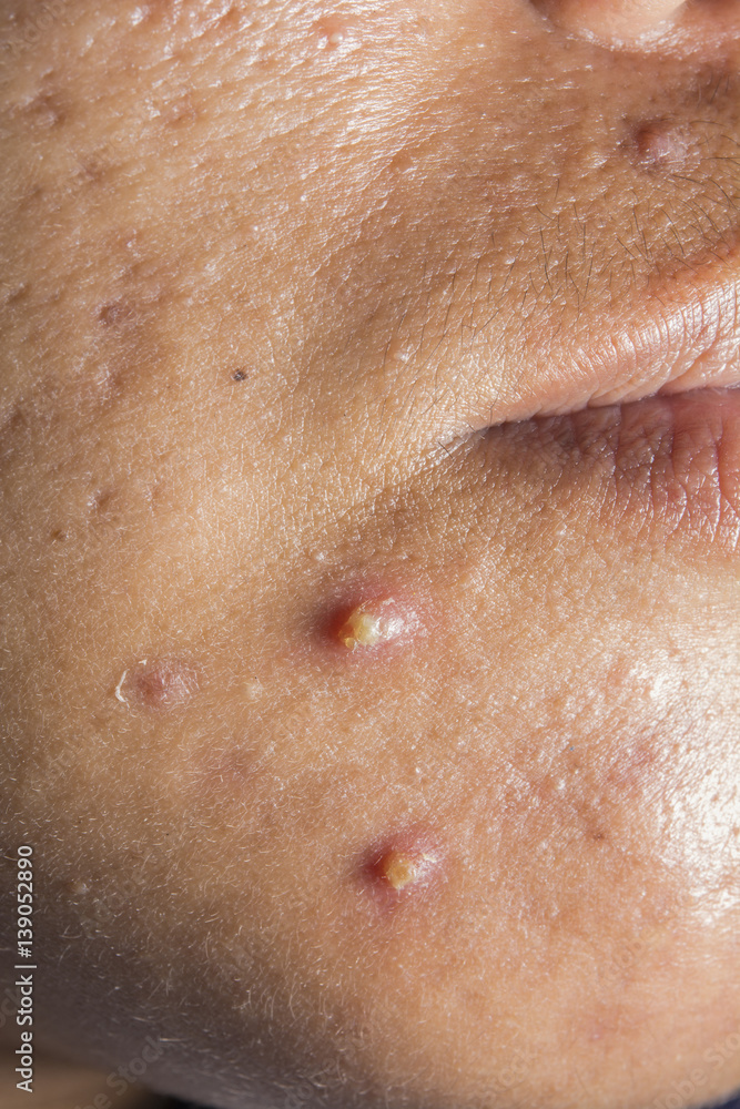 Fototapeta premium closeup for two acne on chin