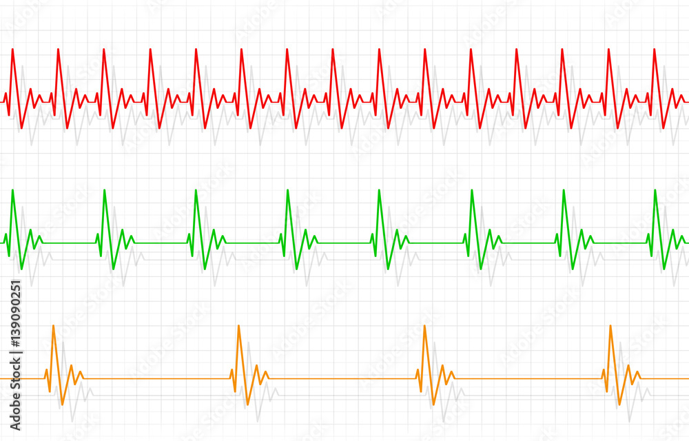 Different Heartbeats Illustration Different Heartbeats Illustration