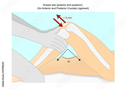 Drawer test: to check the integrity of the anterior and posterior cruciate ligament of the knee