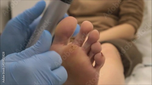 Dermatologist performs medical examination using dermatoscope to find plantar wart  photo