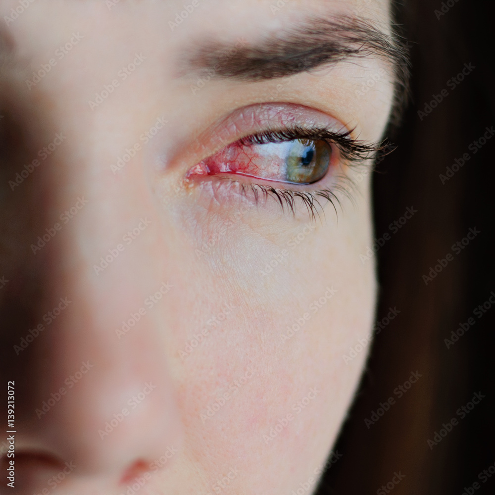 Obraz premium Zbliżenie na podrażnione lub zakażone czerwone przekrwione oczy - zapalenie spojówek