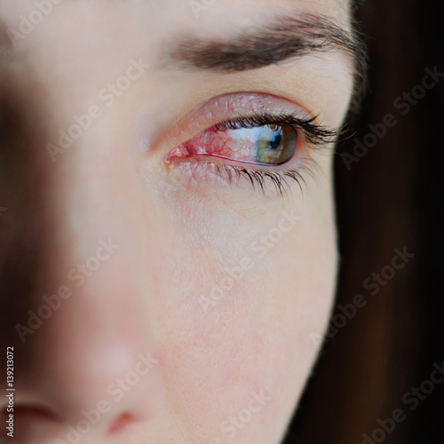 Closeup of irritated or infected red bloodshot eyes - conjunctivitis