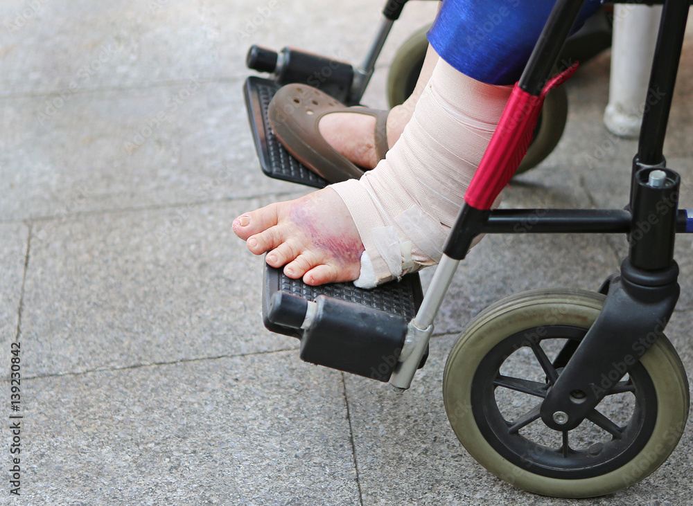 Obraz premium injured ankle with bandage of woman on wheelchair