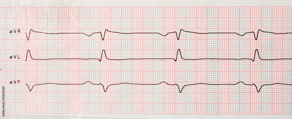 Results of cardiogram on sheet of paper Results of cardiogram on sheet of paper