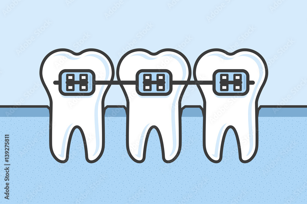 dental braces clipart
