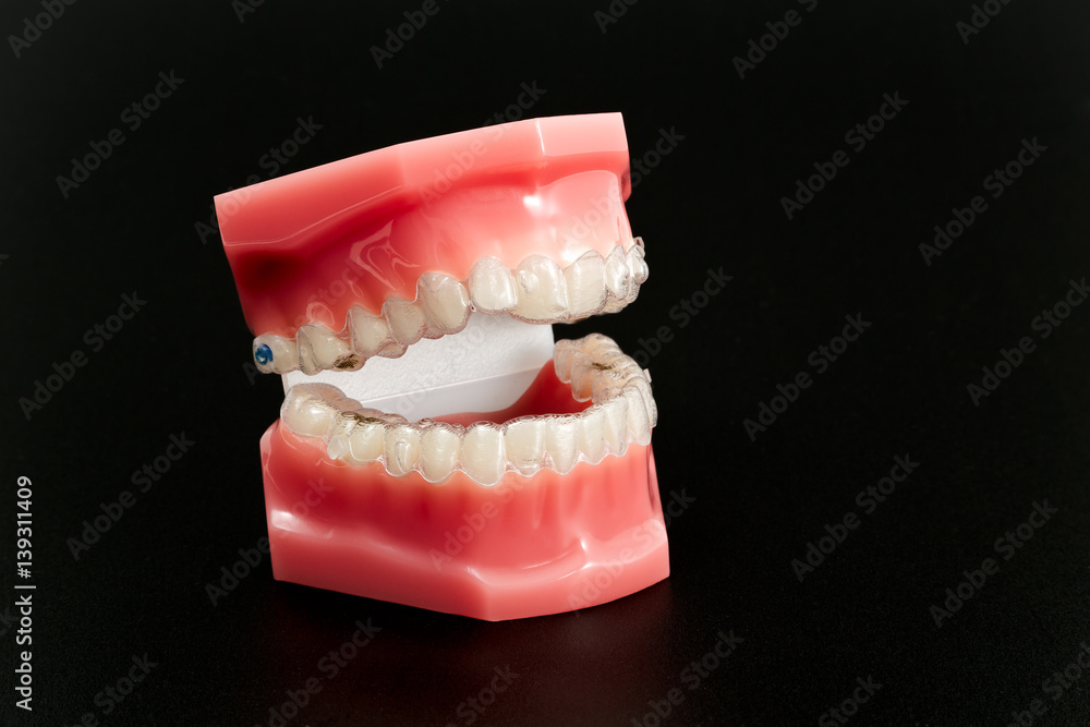 Obraz premium Ortodoncia Invisible 