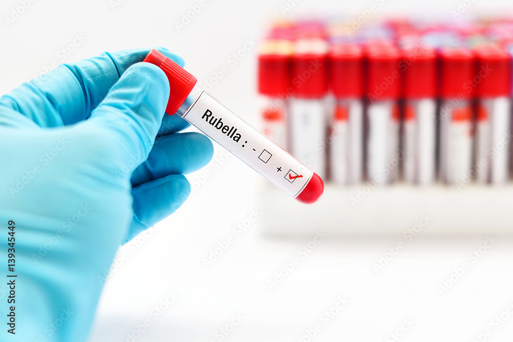 Obraz premium Blood sample positive with rubella virus