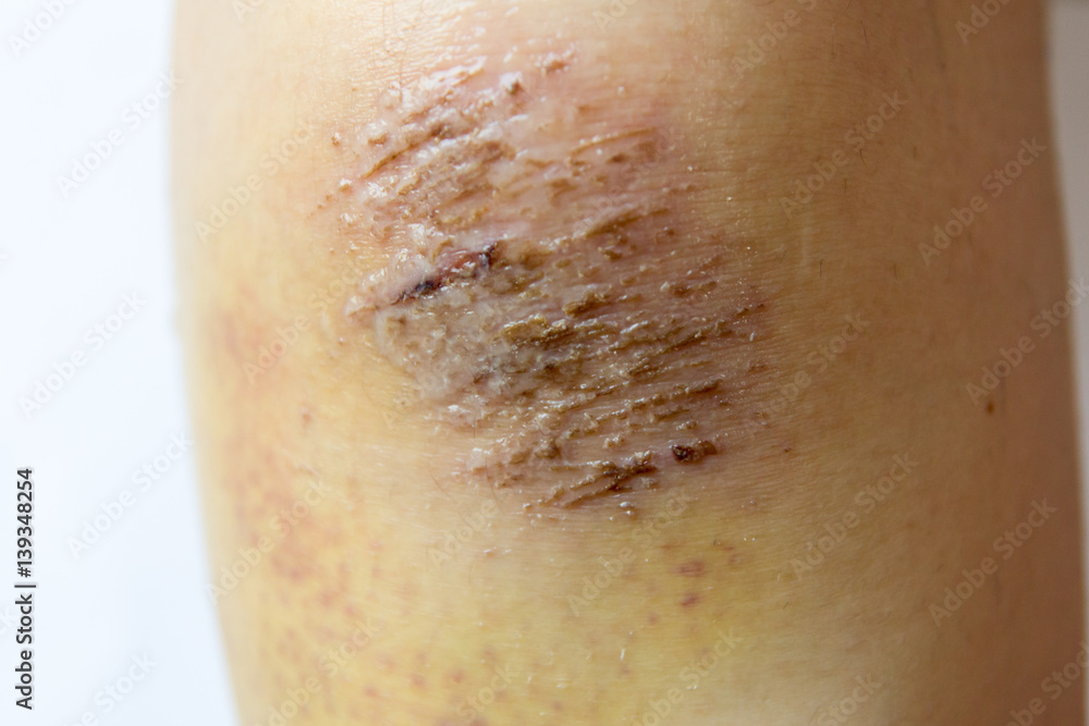 Fototapeta premium Closed up of red scab injury on woman knee background