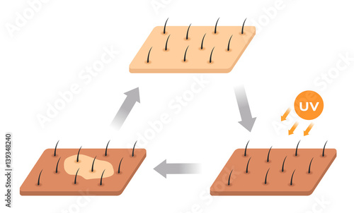 skin life cycle . uv makes skin dark and it peeling off