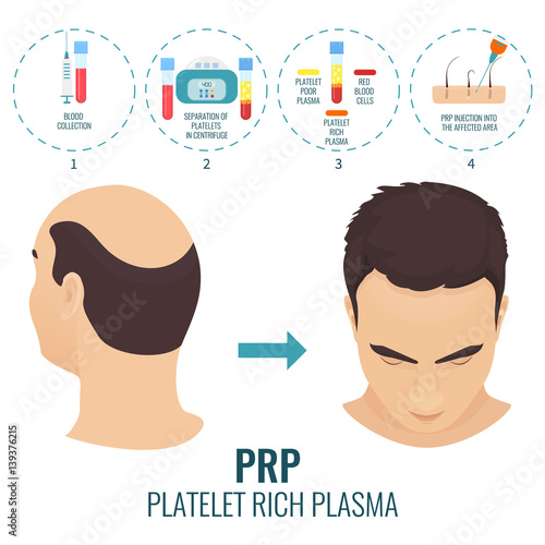 Male hair loss treatment with platelet rich plasma injection. Stages of PRP procedure. Alopecia infographic medical template for transplantation clinics and diagnostic centers. Vector illustration.
