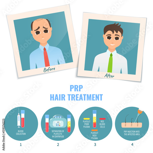 Photographs of a man before and after PRP treatment. Platelet rich plasma procedure stages. Male hair loss design template. Alopecia medical concept. Vector illustration.