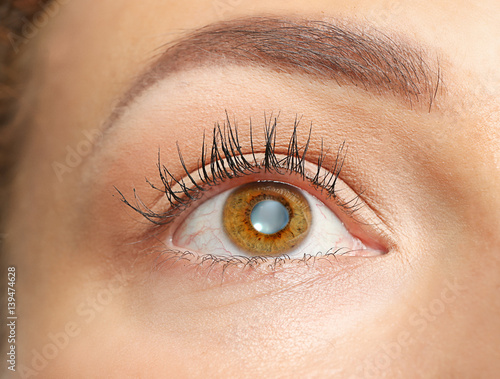 Cuadro en lienzo Cataract concept. Young woman's eye, closeup