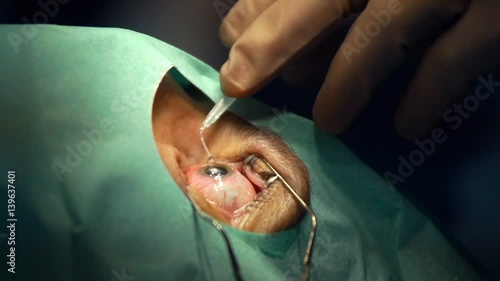 anesthesia before laser surgery vision correction, ophthalmology operation, Surgeon's hands in gloves performing laser eye vision correction correction, surgery eye, Cataract surgery