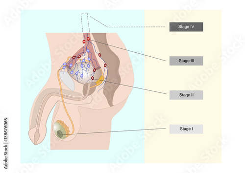 One of the many types of testicular cancer and its spreading