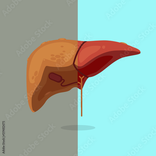 cirrhosis-06