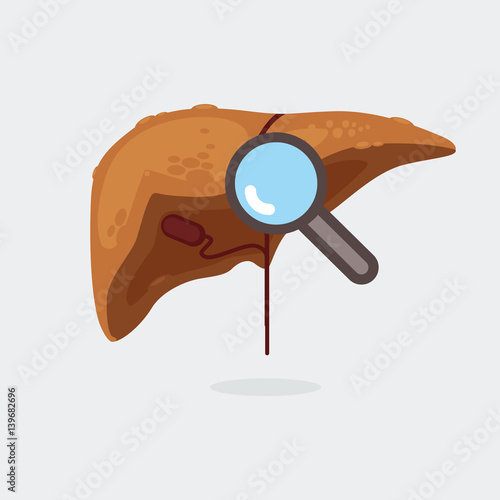 liver cirrhosis vector illustration