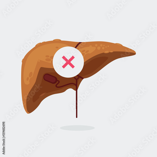liver cirrhosis vector illustration