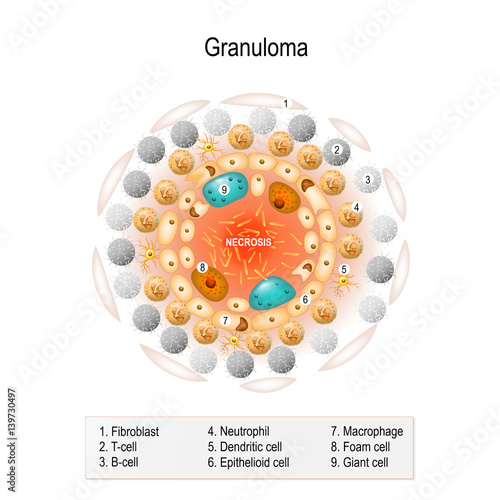 granuloma photo